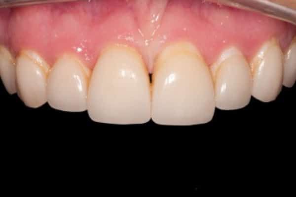 Veneers before