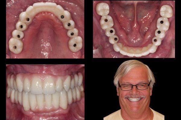 Fixed Implant Bridge