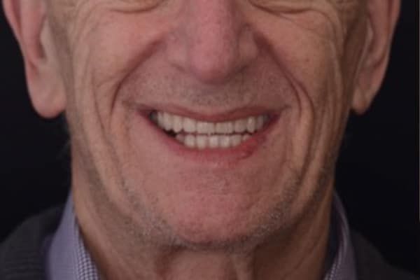 crowns, veneers, and full mouth reconstruction after