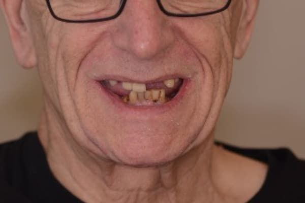crowns, veneers, and full mouth reconstruction before