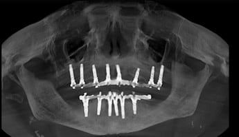 Full Mouth Dental Implants