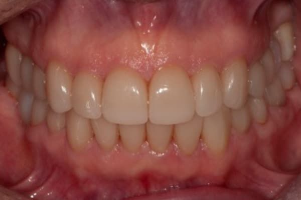 crowns, veneers, and full mouth reconstruction after