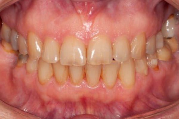crowns, veneers, and full mouth reconstruction before