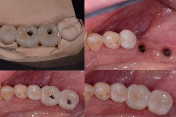 Single Implant Cases
