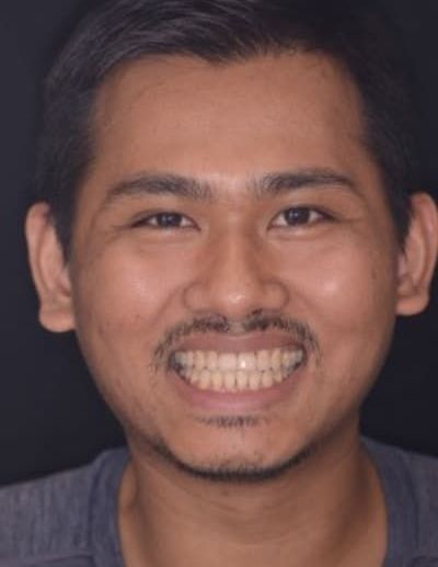 Invisalign After