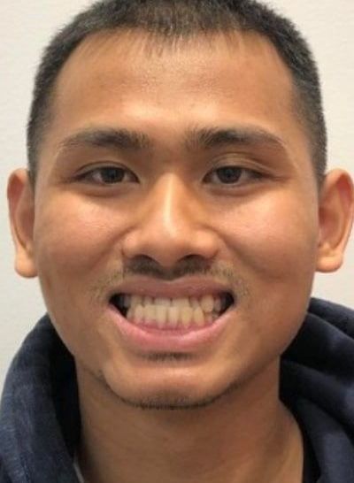 Invisalign Before