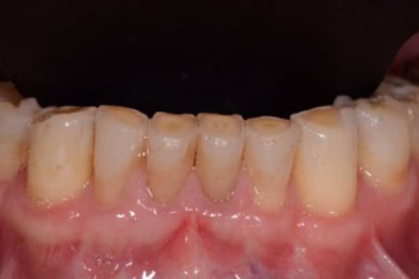 Lower Front Teeth Before
