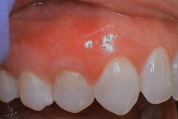 Periodontal Surgery After