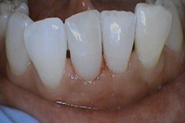 crowns, veneers, and full mouth reconstruction after