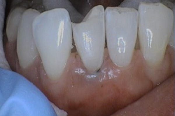 crowns, veneers, and full mouth reconstruction before