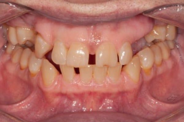 Dentures Before