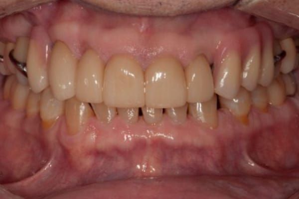 Dentures After