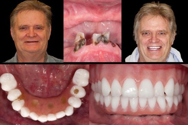 Implant Hybrid Prosthesis