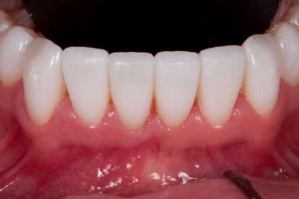 Veneers after