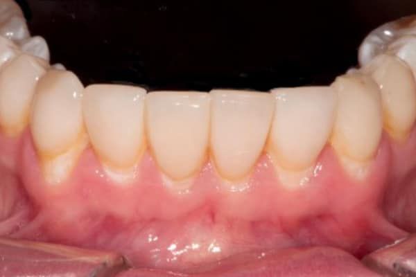 Veneers before