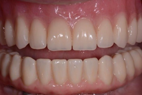 crowns, veneers, and full mouth reconstruction after