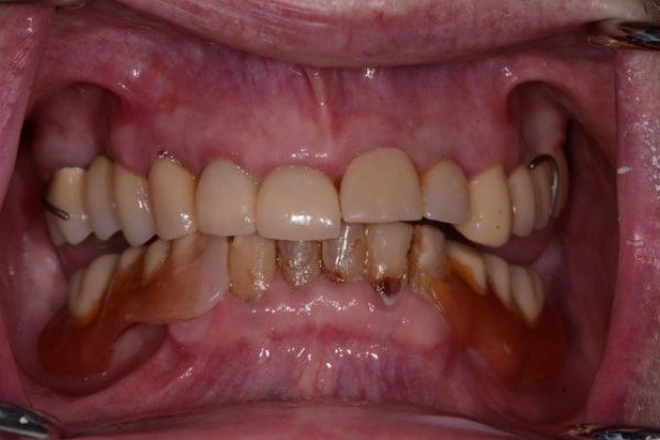 crowns, veneers, and full mouth reconstruction before