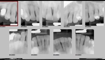 Full Mouth Dental Implants