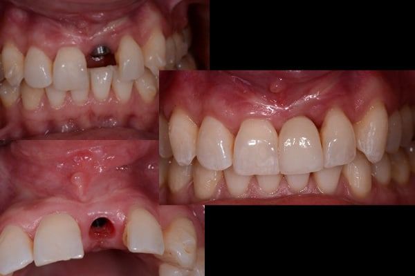 Single Implant Cases