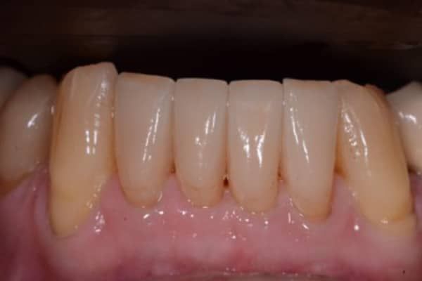 Lower Front Teeth After