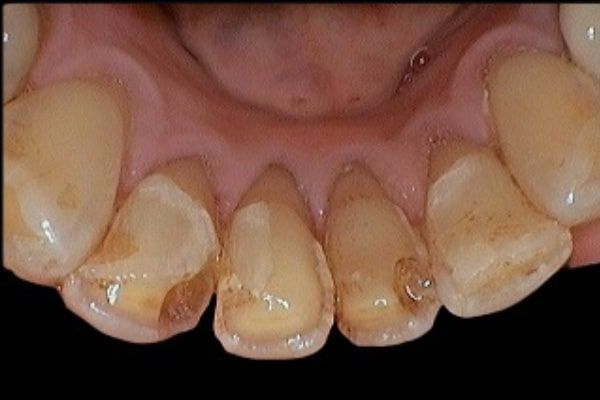 Lower Front Teeth Before