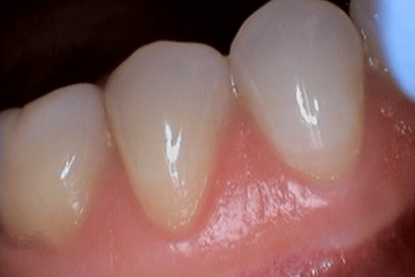 Dental Emergency Before