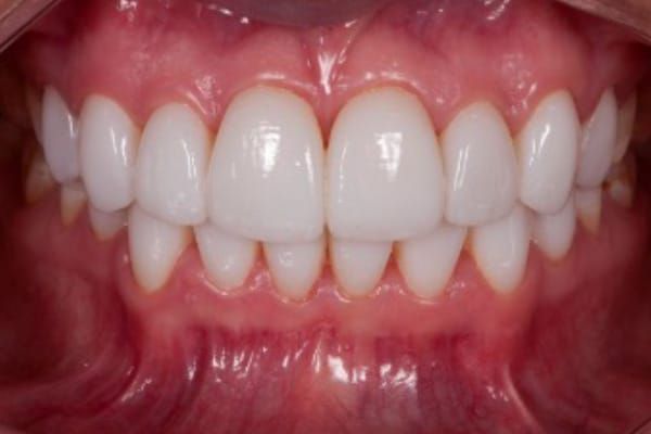 Veneers after