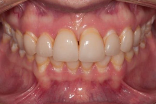 Veneers before