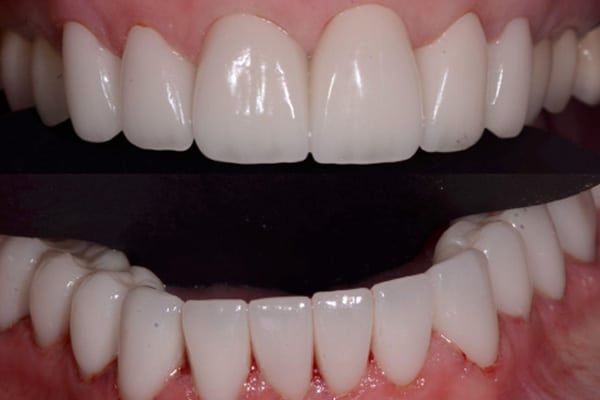 crowns, veneers, and full mouth reconstruction after