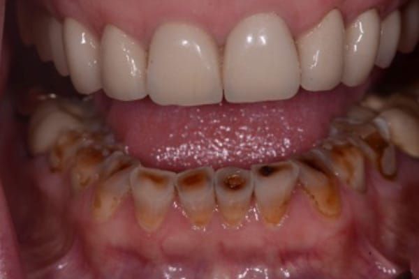 crowns, veneers, and full mouth reconstruction before