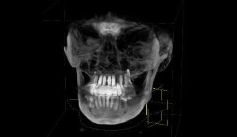 Full Mouth Dental Implants