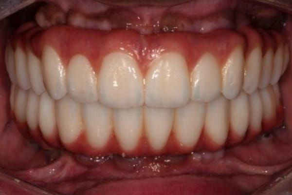 crowns, veneers, and full mouth reconstruction after