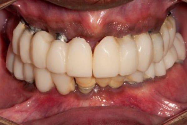 crowns, veneers, and full mouth reconstruction before