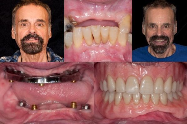 Implant Overdentures