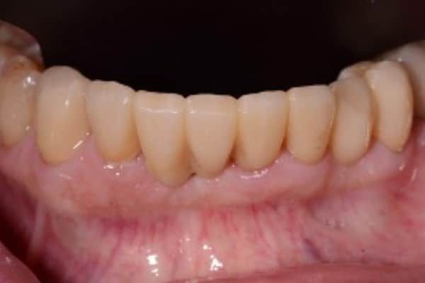 Lower Front Teeth After