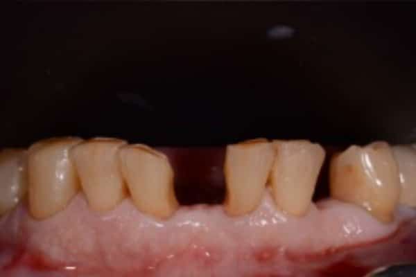 Lower Front Teeth Before