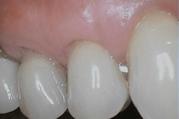 Periodontal Surgery After