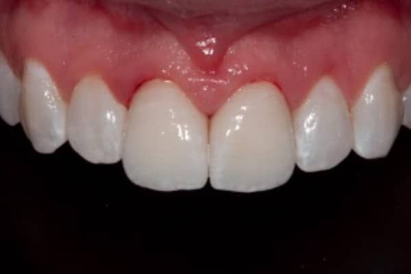 Dental Emergency After
