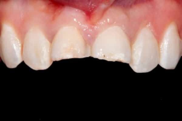 Dental Emergency Before