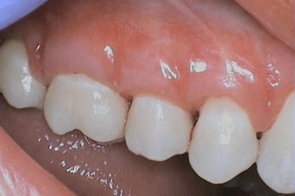 Periodontal Surgery After