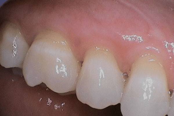Periodontal Surgery Before