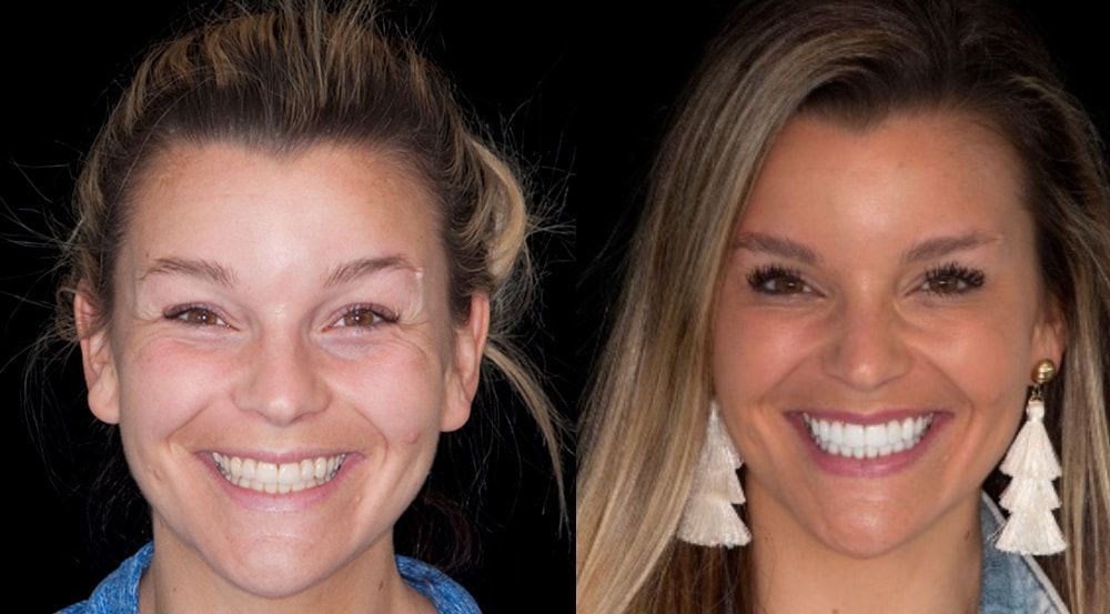 Veneers Before and After