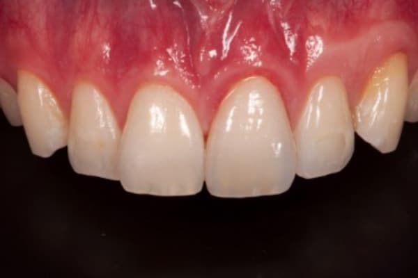 Dental Emergency After