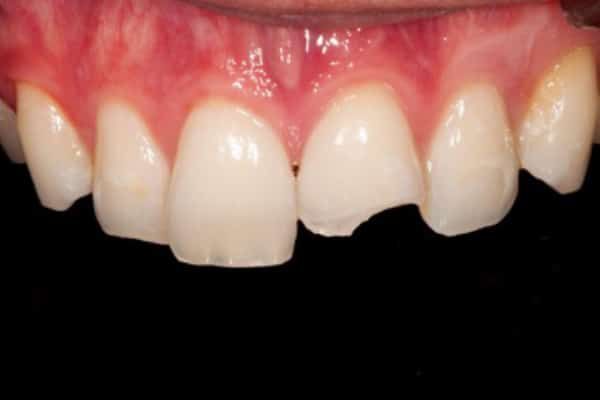 Dental Emergency Before