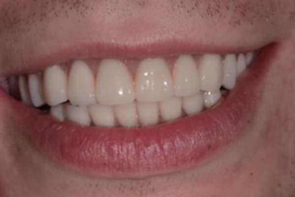 Dentures After