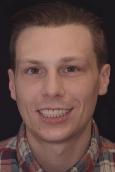 Case B After Portrait