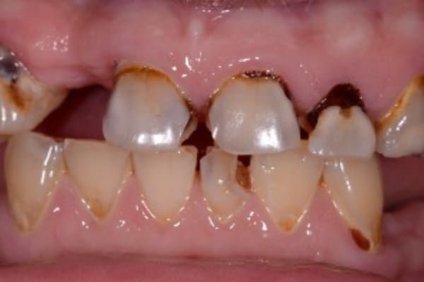 Dentures Before