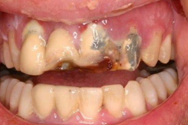 Dental Emergency Before
