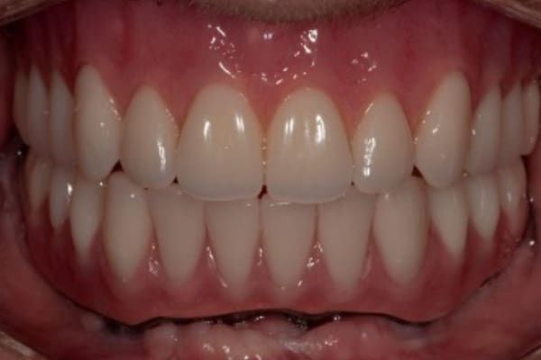 Dentures After