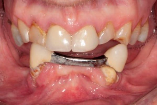 Denture Before